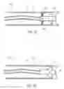 Fig. 03 - Methods and devices for intracorporeal bonding of implants with thermal energy