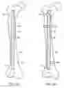 Fig. 21 - Methods and devices for intracorporeal bonding of implants with thermal energy