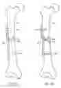 Fig. 23 - Methods and devices for intracorporeal bonding of implants with thermal energy