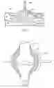 Fig. 34 - Methods and devices for intracorporeal bonding of implants with thermal energy