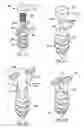Fig. 43 - Methods and devices for intracorporeal bonding of implants with thermal energy