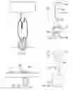 Fig. 68 - Methods and devices for intracorporeal bonding of implants with thermal energy