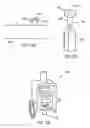 Fig. 72 - Methods and devices for intracorporeal bonding of implants with thermal energy