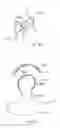 Fig. 83 - Methods and devices for intracorporeal bonding of implants with thermal energy