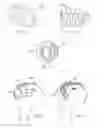 Fig. 85 - Methods and devices for intracorporeal bonding of implants with thermal energy