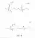 Fig. 07 - Ablation catheter with high-resolution electrode assembly