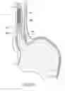 Fig. 45 - DEVICES, SYSTEMS AND METHODS FOR TREATING TISSUE REGIONS OF THE BODY