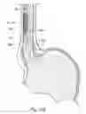 Fig. 46 - DEVICES, SYSTEMS AND METHODS FOR TREATING TISSUE REGIONS OF THE BODY