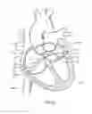 Fig. 15 - Method of surgical perforation via the delivery of energy