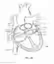 Fig. 18 - Method of surgical perforation via the delivery of energy