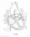 Fig. 19 - Method of surgical perforation via the delivery of energy