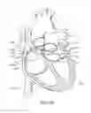 Fig. 24 - Method of surgical perforation via the delivery of energy