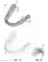 Fig. 02 - DENTAL POSITIONING APPLIANCE HAVING METALLIC PORTION