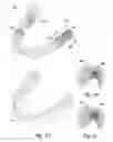 Fig. 03 - DENTAL POSITIONING APPLIANCE HAVING METALLIC PORTION
