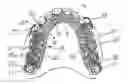 Fig. 01 - Removable denture with metal denture tooth or teeth