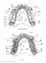 Fig. 02 - Removable denture with metal denture tooth or teeth