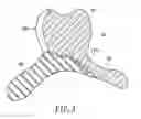 Fig. 03 - Removable denture with metal denture tooth or teeth