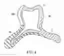 Fig. 04 - Removable denture with metal denture tooth or teeth