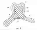 Fig. 05 - Removable denture with metal denture tooth or teeth