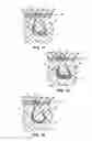 Fig. 08 - Structural support incorporating multiple strands