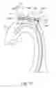 Fig. 09 - Embolic protection device and method