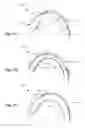 Fig. 15 - Embolic protection device and method