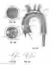 Fig. 16 - Embolic protection device and method