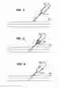 Fig. 04 - INFUSION FILTER AND METHOD FOR PERFORMING THROMBOLYSIS