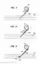 Fig. 05 - INFUSION FILTER AND METHOD FOR PERFORMING THROMBOLYSIS