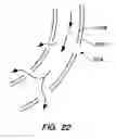 Fig. 11 - INFUSION FILTER AND METHOD FOR PERFORMING THROMBOLYSIS