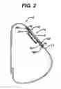 Fig. 03 - Injection zone markers for biomedical implants