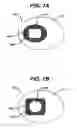 Fig. 08 - Injection zone markers for biomedical implants