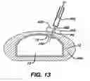 Fig. 13 - Injection zone markers for biomedical implants