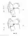 Fig. 08 - System and method for reducing tricuspid regurgitation