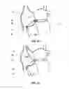 Fig. 09 - System and method for reducing tricuspid regurgitation