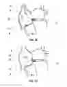 Fig. 10 - System and method for reducing tricuspid regurgitation