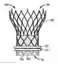 Fig. 01 - Paravalvular sealing via extended cuff mechanisms