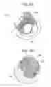 Fig. 06 - Stent-valves for valve replacement and associated methods and systems for surgery