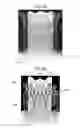 Fig. 10 - Stent-valves for valve replacement and associated methods and systems for surgery