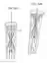 Fig. 32 - Stent-valves for valve replacement and associated methods and systems for surgery