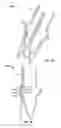 Fig. 09 - Two-stage collapsible/expandable prosthetic heart valves and anchoring systems