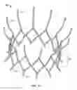 Fig. 13 - Two-stage collapsible/expandable prosthetic heart valves and anchoring systems
