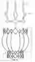 Fig. 16 - Two-stage collapsible/expandable prosthetic heart valves and anchoring systems