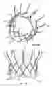 Fig. 23 - Two-stage collapsible/expandable prosthetic heart valves and anchoring systems