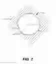Fig. 03 - Paravalvular leak protection