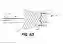 Fig. 10 - Paravalvular leak protection