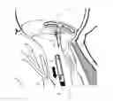 Fig. 01 - Implant and method for improving coaptation of an atrioventricular valve