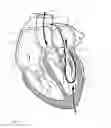 Fig. 02 - Implant and method for improving coaptation of an atrioventricular valve