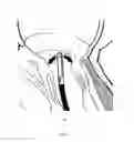 Fig. 05 - Implant and method for improving coaptation of an atrioventricular valve