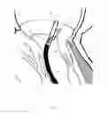 Fig. 06 - Implant and method for improving coaptation of an atrioventricular valve